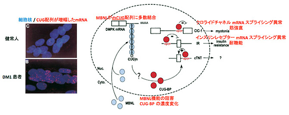 図1　DM1患者筋細胞核内での異常mRNAの蓄積とそれがもたらす病態